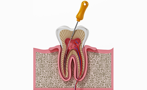 Endodontic Therapies